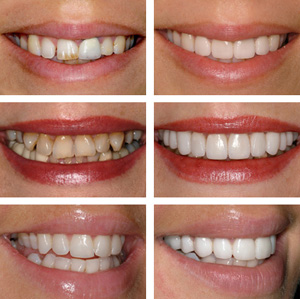 Veneers