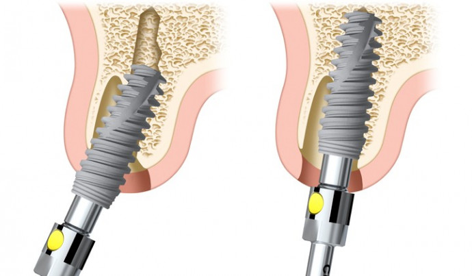 implantation_thumbWith690