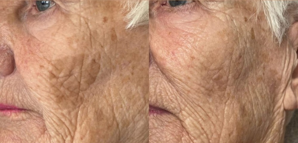 voor en na behandeling van lentiges met laser