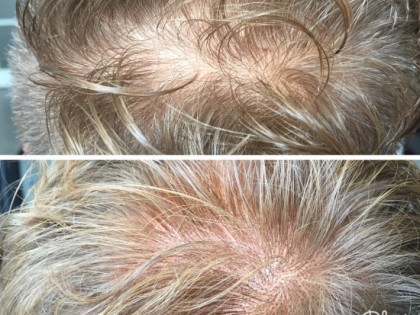 Scalp_pigmentatie (1)