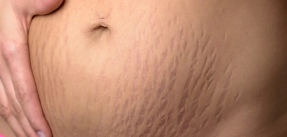 striae op de buik na zwangerschap