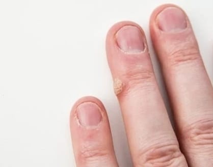 wrat op de vinger