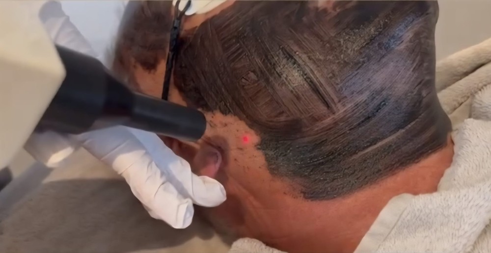 carbon peel