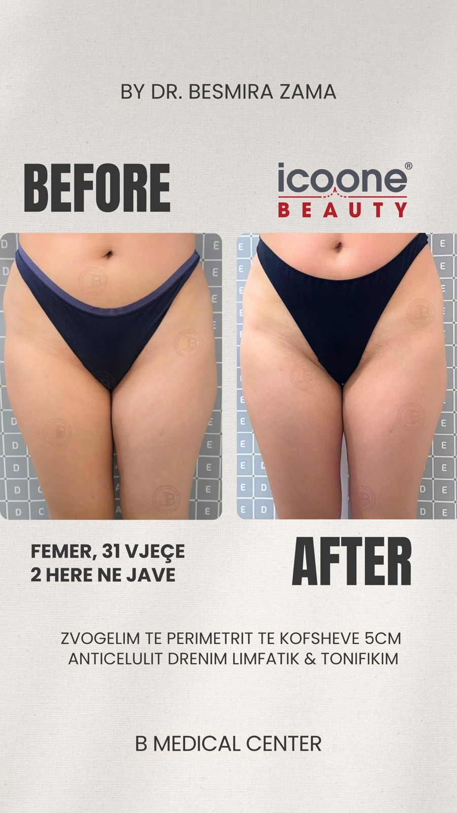 Zvogëlim perimetrit të kofshëve 5cm