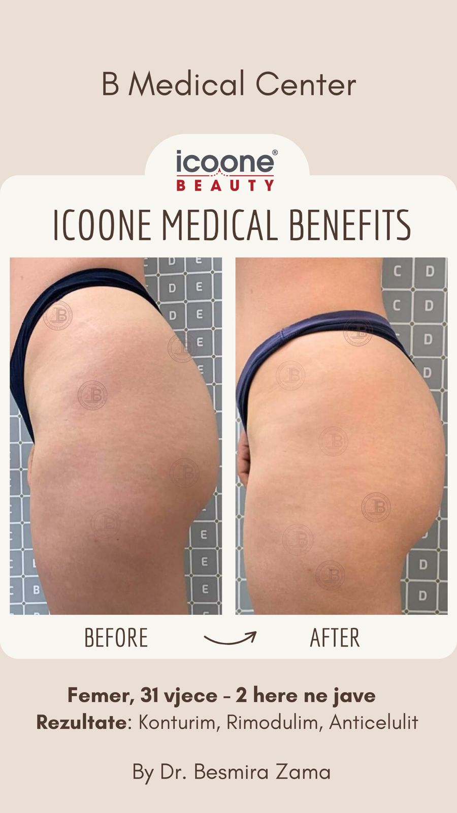 Konturim, Rimodulim, Anticelulit