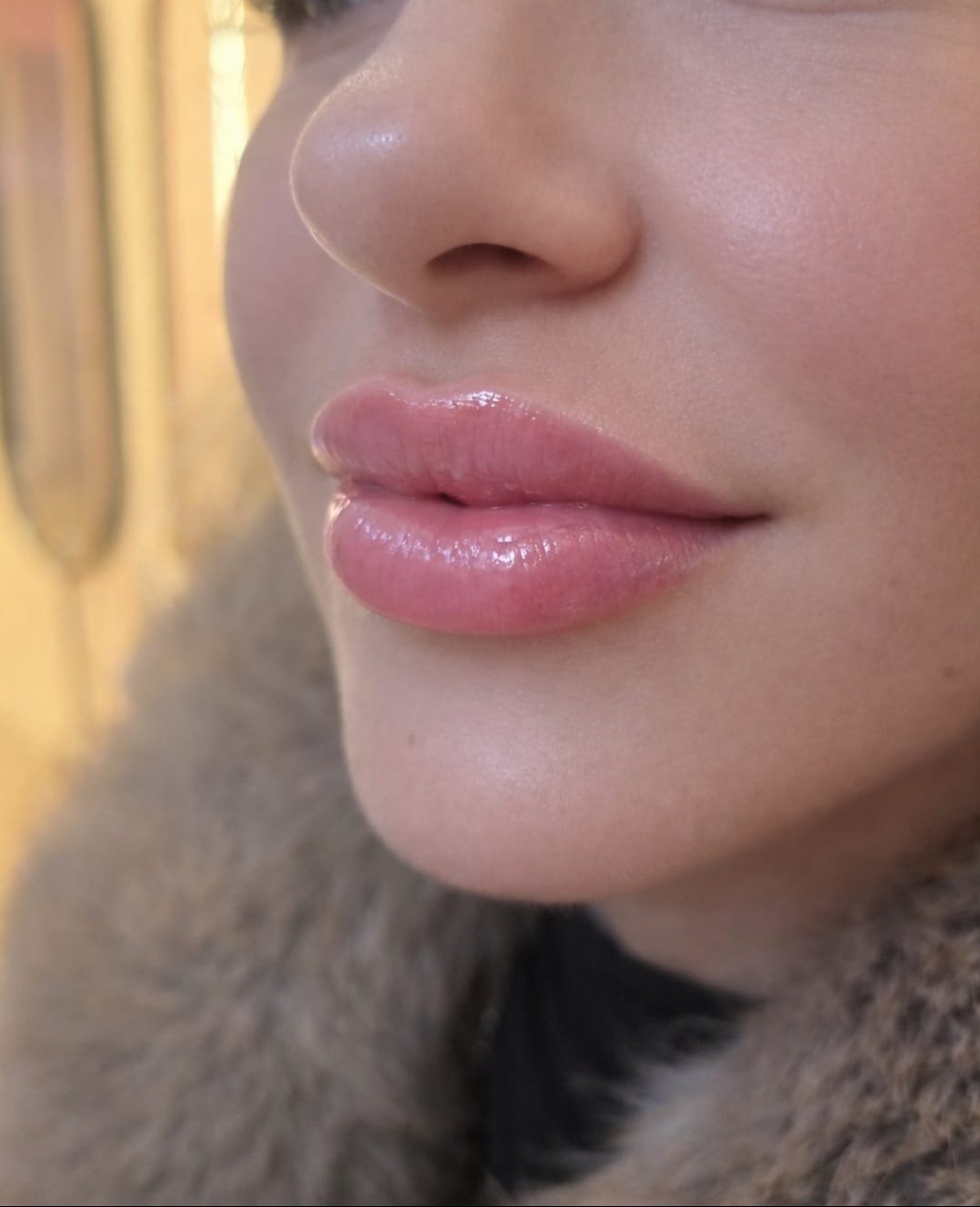 Lip Filler, age 23