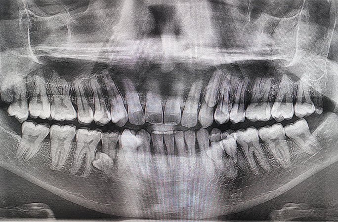 Фотография мужчины с необычно большим количеством зубов, сидящего на приеме у стоматолога.