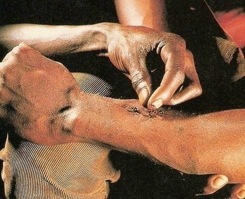 Муравьи-хирурги, сцепленные друг с другом, имитируют процесс зашивания раны