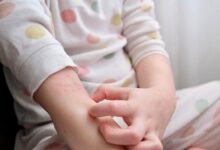 Дети с чистой кожей после лечения от леопардовых пятен