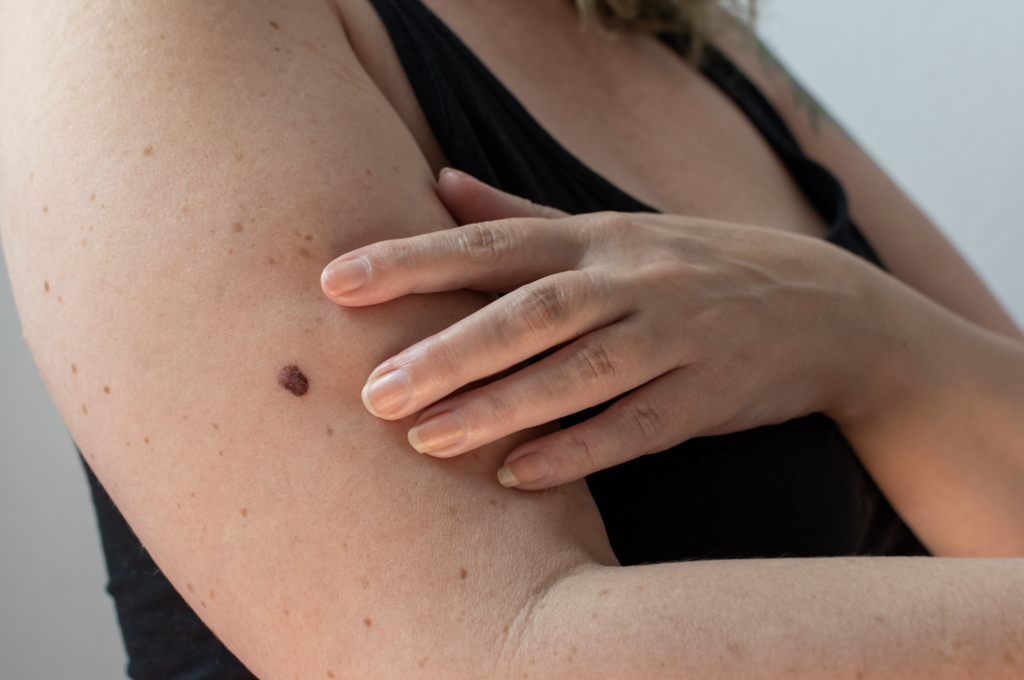 Día Mundial del Melanoma: Un tipo de tumor que crece en la Argentina