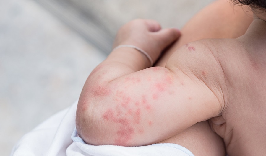 Campaña para detectar alergia alimentaria en bebés